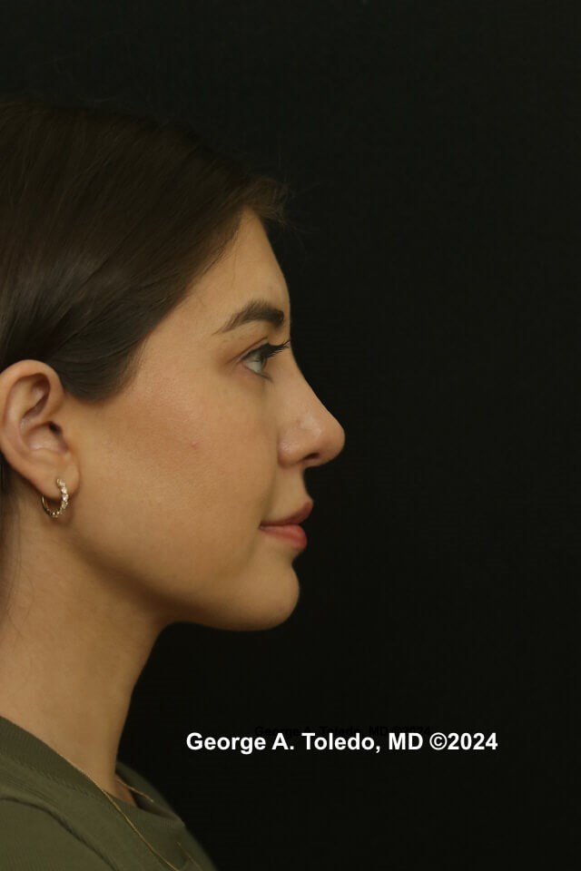 Rhinoplasty Before and After After