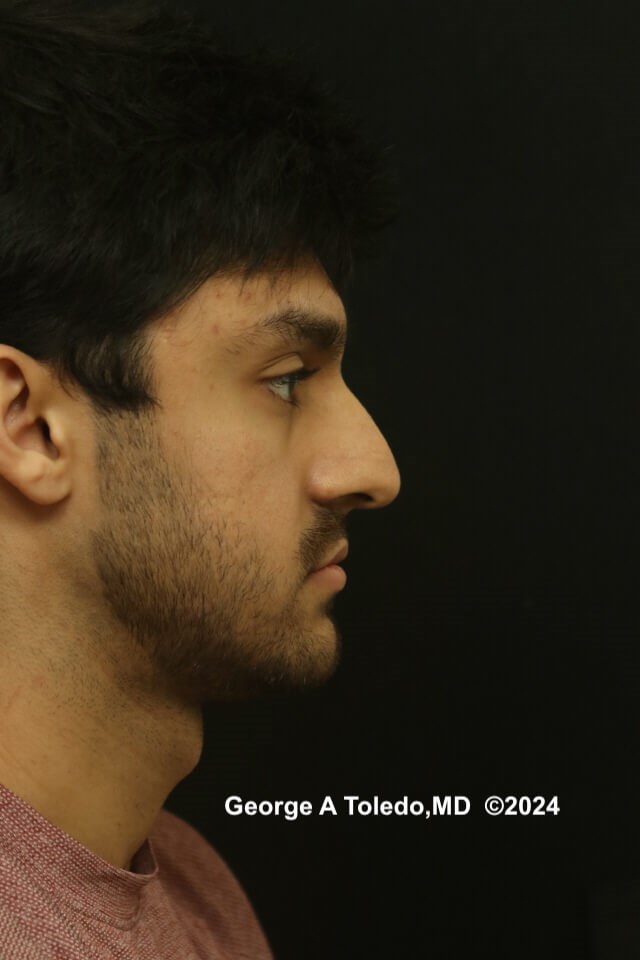 Ethnic Rhinoplasty Results Before