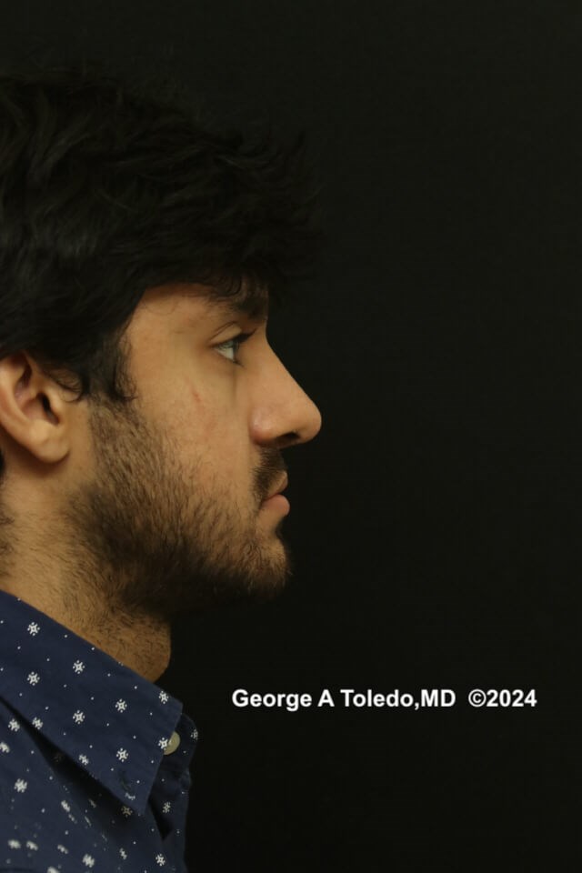 Ethnic Rhinoplasty Results After