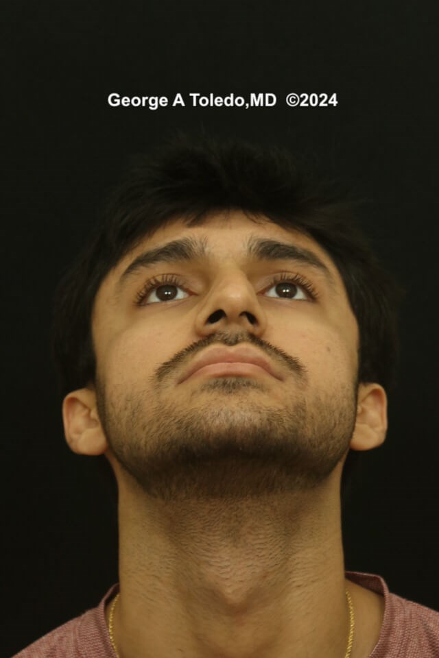 Ethnic Rhinoplasty Results Before