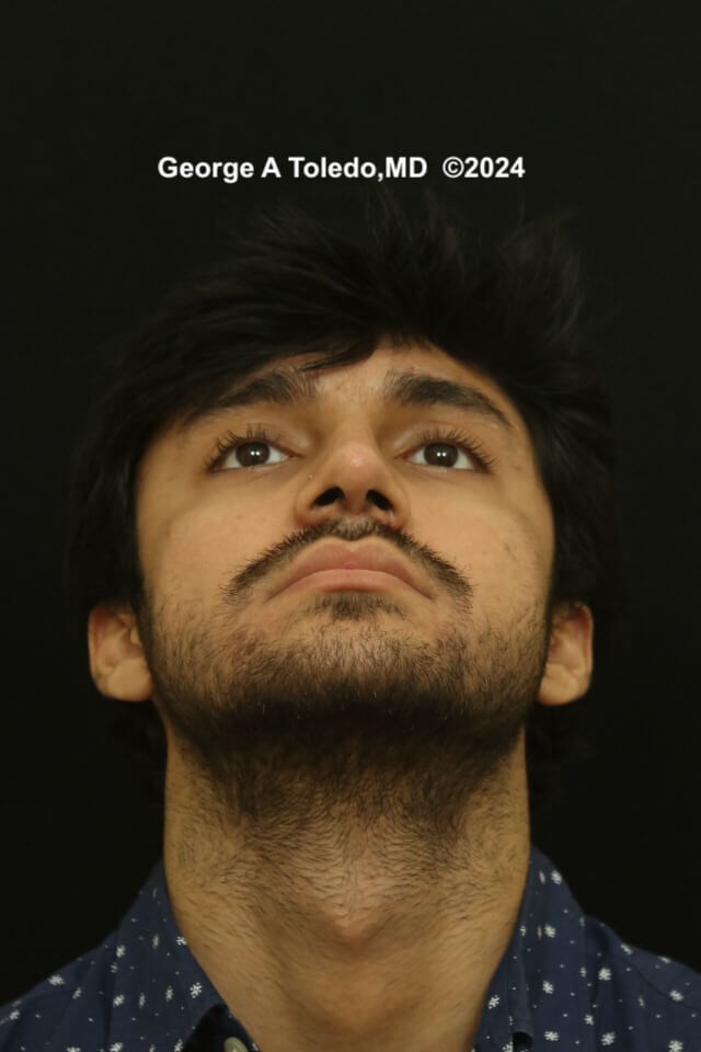 Ethnic Rhinoplasty Results After