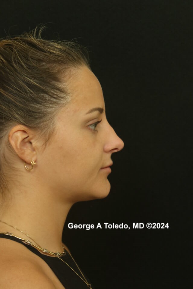 Revision Rhinoplasty Results Before
