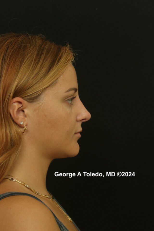 Revision Rhinoplasty Results After