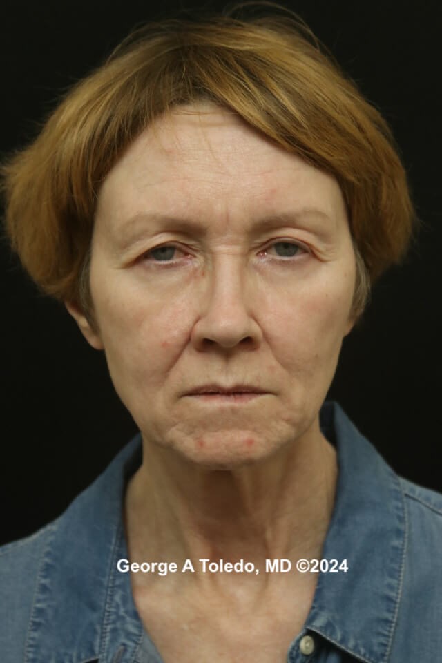 Face & Brow Lift Results Before