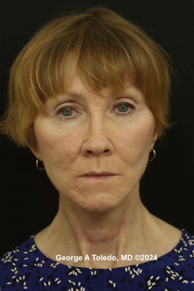 Face & Brow Lift Results After