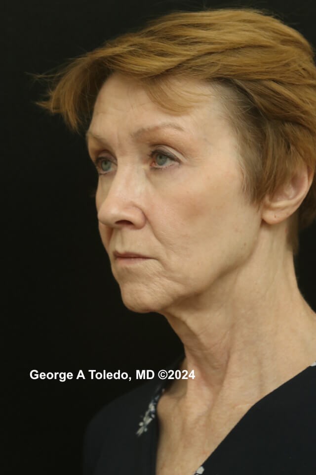 Face & Brow Lift Results Before