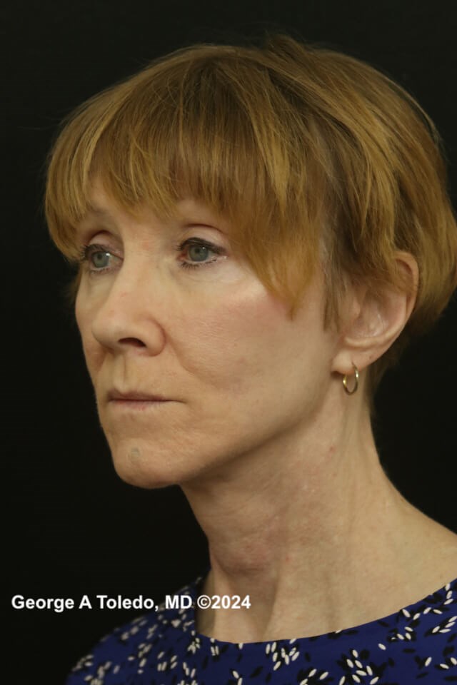 Face & Brow Lift Results After