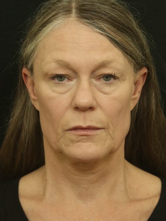 Facial Rejuvenation Before