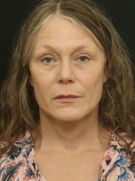 Facial Rejuvenation After