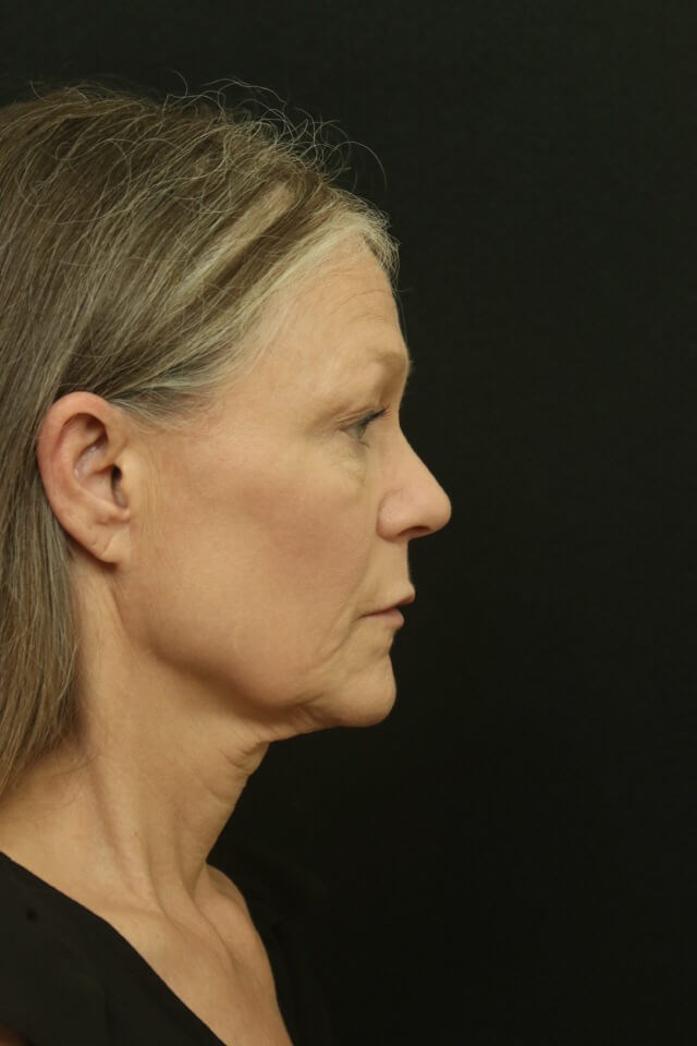 Facial Rejuvenation Before