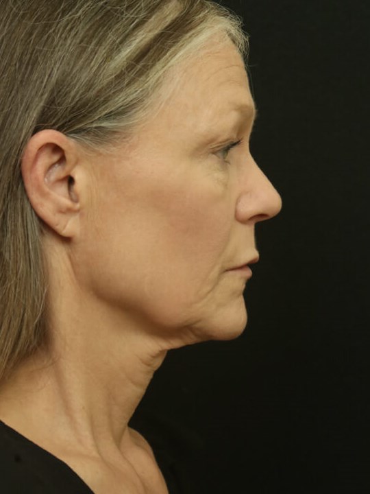 Facial Rejuvenation Before