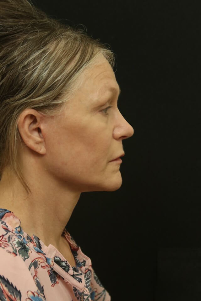 Facial Rejuvenation After