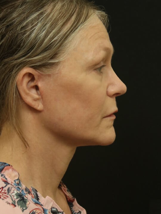 Facial Rejuvenation After