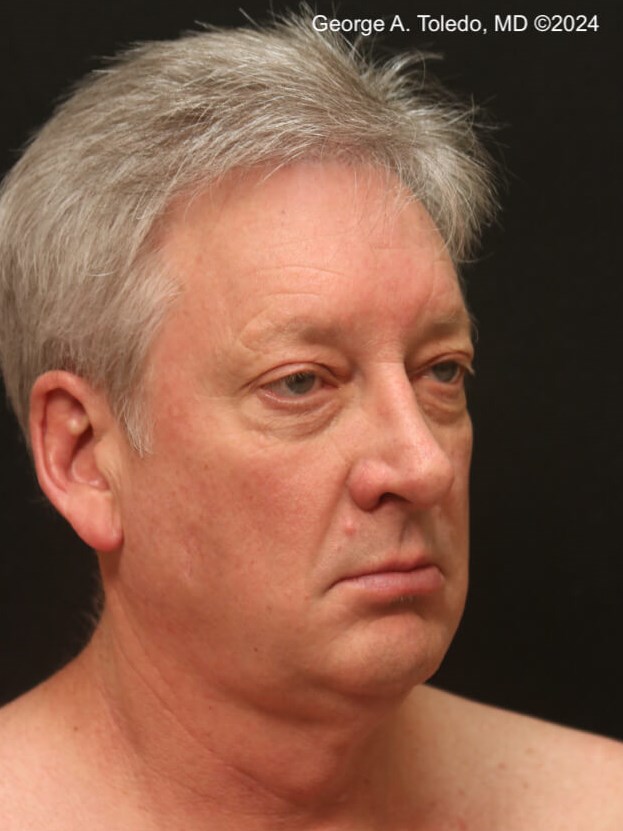 Male Facelift Results Before