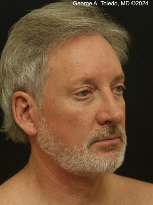 Male Facelift Results After