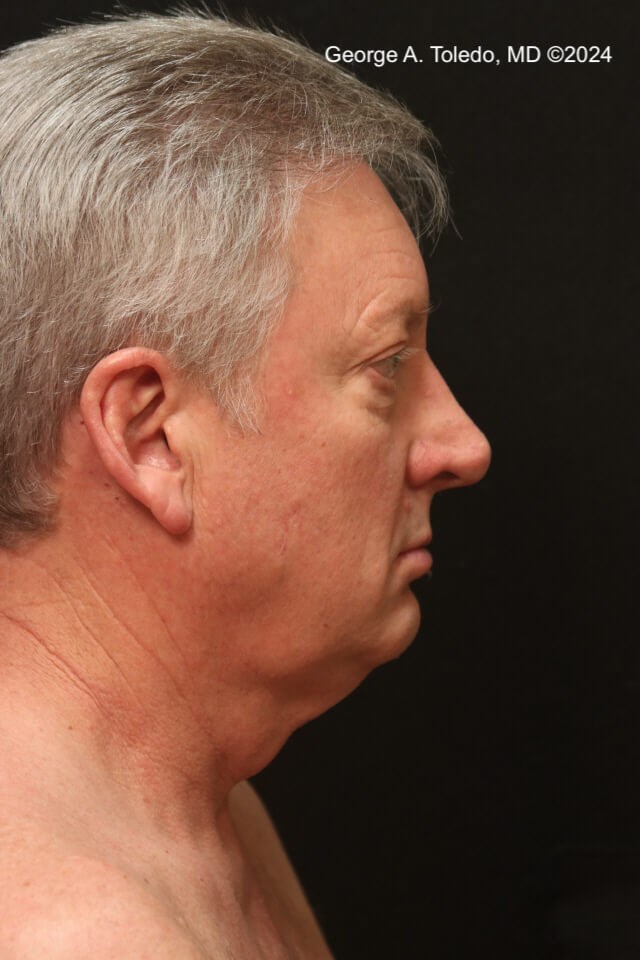 Male Facelift Results Before