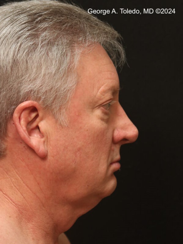 Male Facelift Results Before