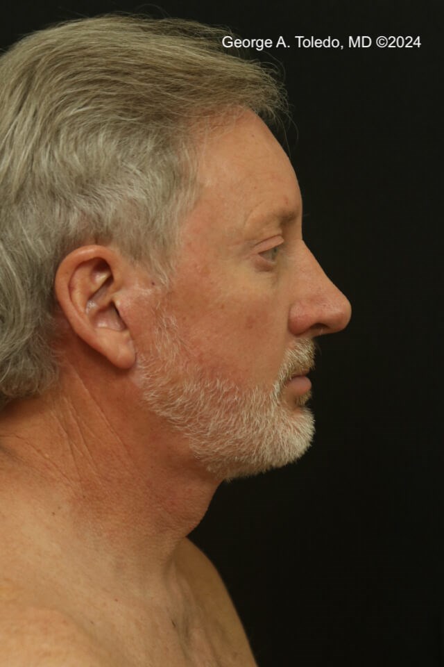 Male Facelift Results After