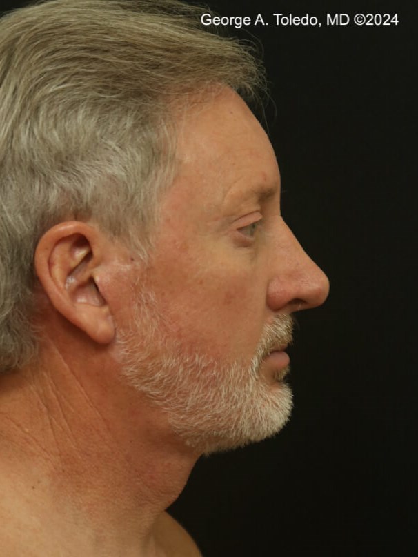 Male Facelift Results After