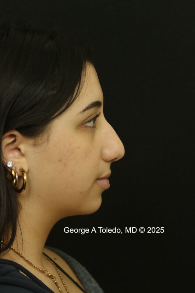 Rhinoplasty Before and After Before