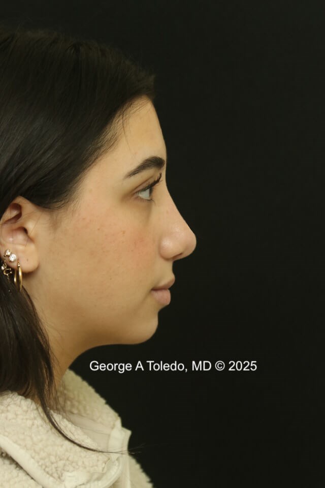 Rhinoplasty Before and After After