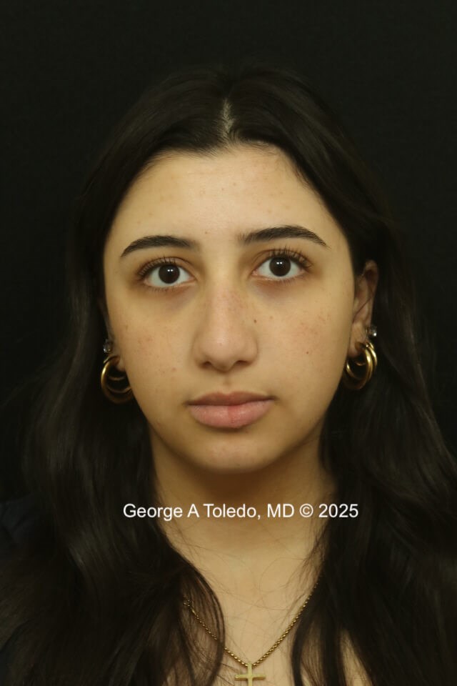 Rhinoplasty Before and After Before