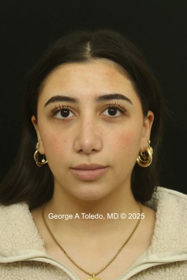 Rhinoplasty Before and After After