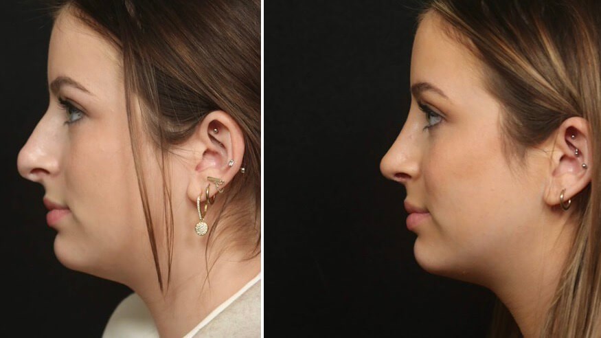 Revision Rhinoplasty 