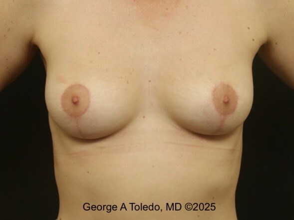 Revision Breast Lift Results After