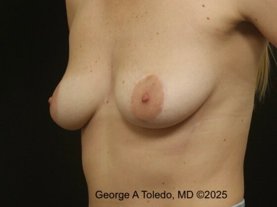 Revision Breast Lift Results Before