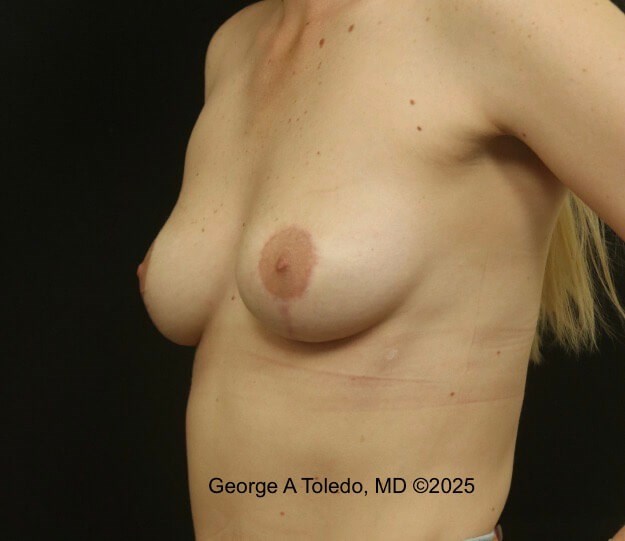 Revision Breast Lift Results After