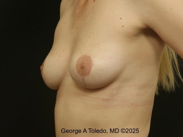 Revision Breast Lift Results After