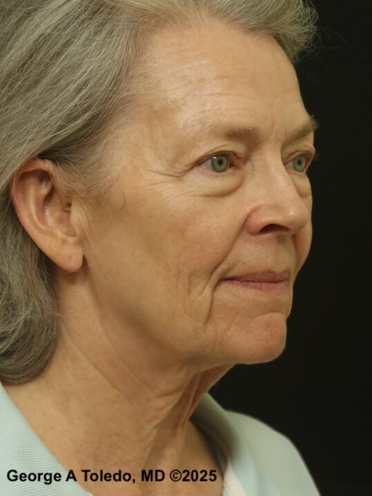 Facial Rejuvenation Results Before