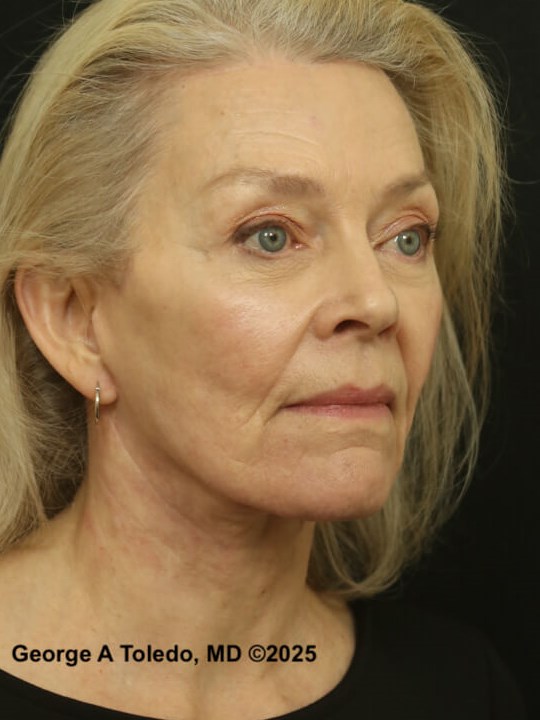 Facial Rejuvenation Results After