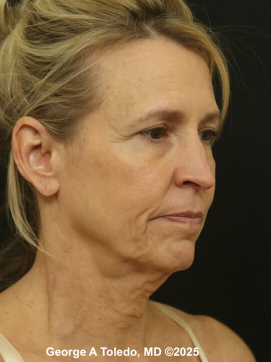 Facelift Rhinoplasty Results Before