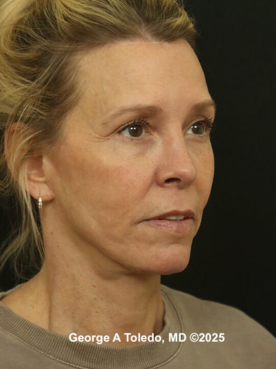 Facelift Rhinoplasty Results After