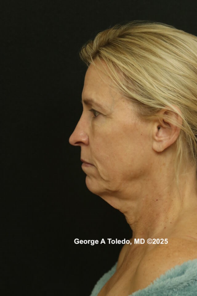 Facelift Rhinoplasty Results Before