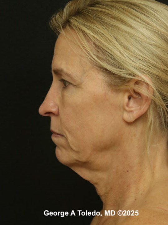 Facelift Rhinoplasty Results Before
