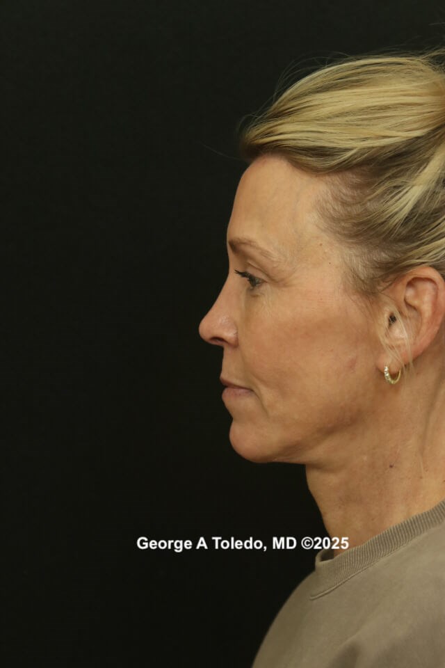 Facelift Rhinoplasty Results After