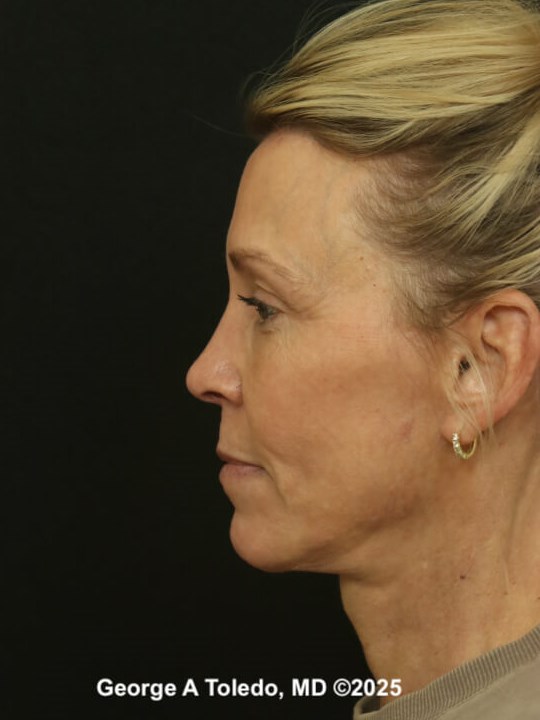 Facelift Rhinoplasty Results After