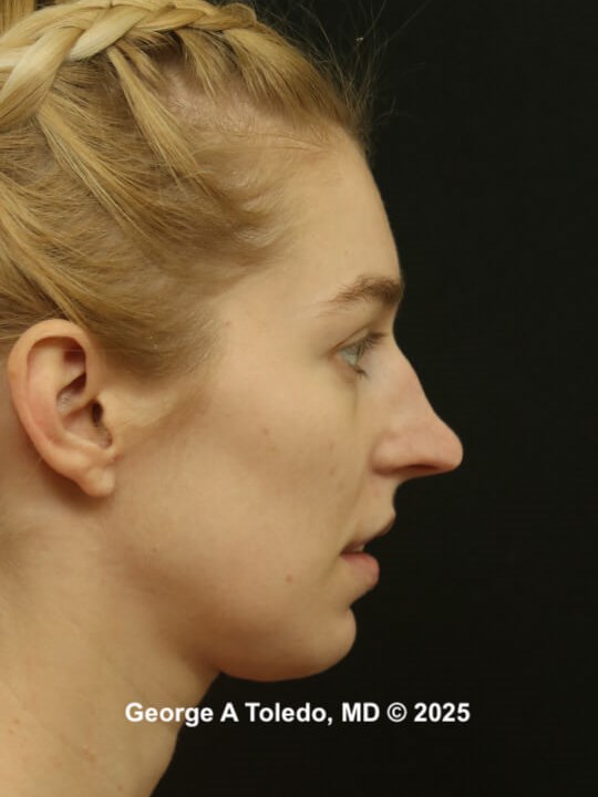 Rhinoplasty Before and Afters Before