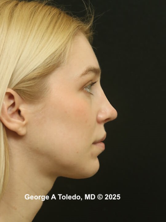 Rhinoplasty Before and Afters After