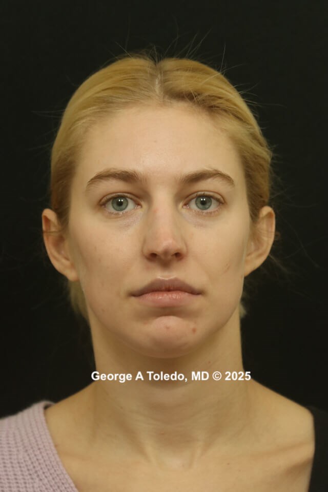 Rhinoplasty Before and Afters Before