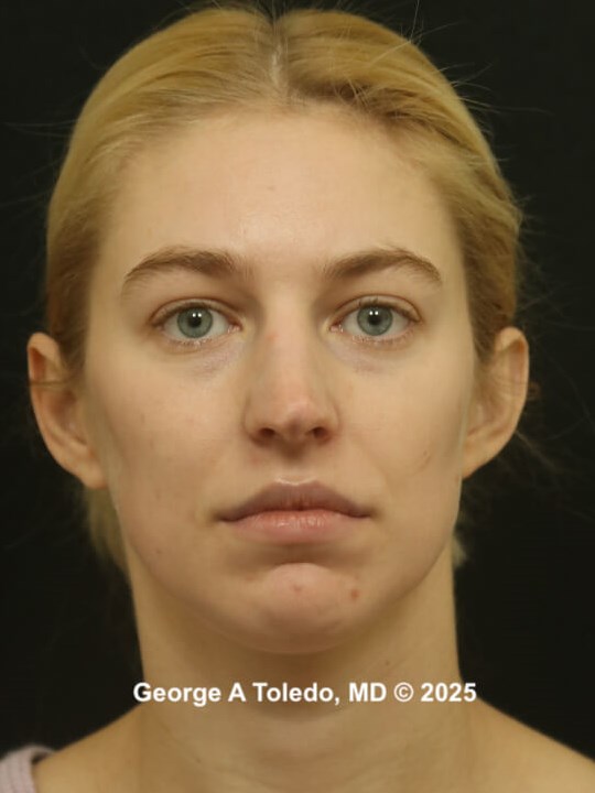 Rhinoplasty Before and Afters Before