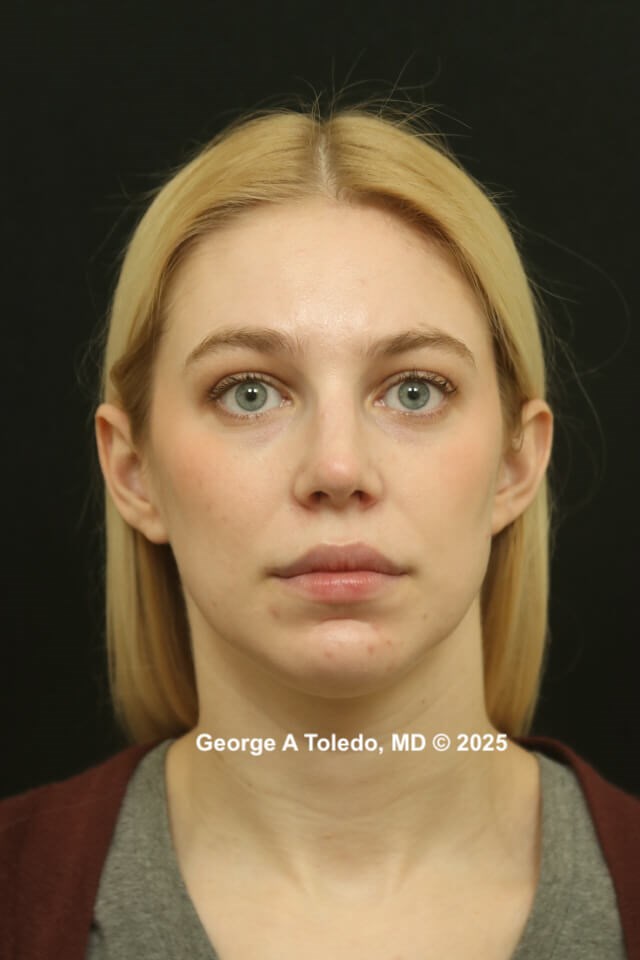 Rhinoplasty Before and Afters After