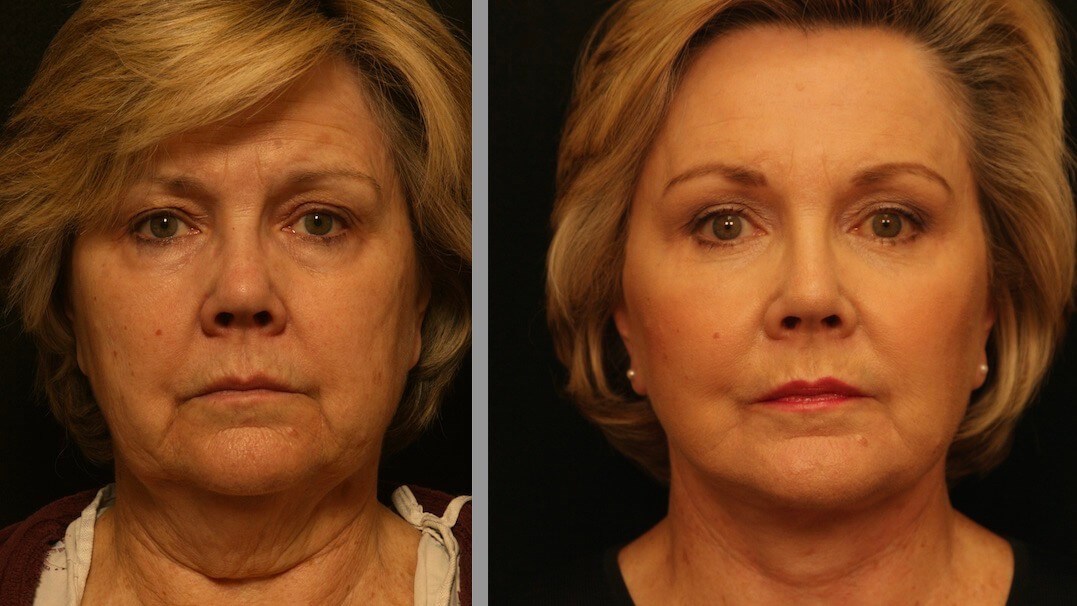 Facelift Results