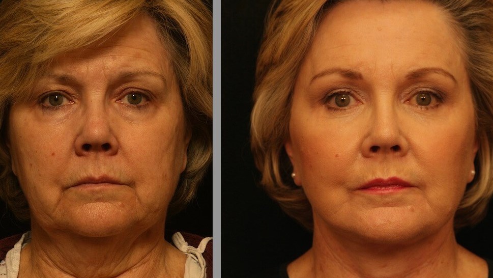 Facelift Results