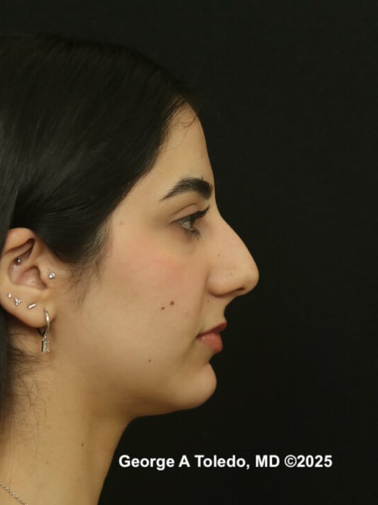 Rhinoplasty Results Before