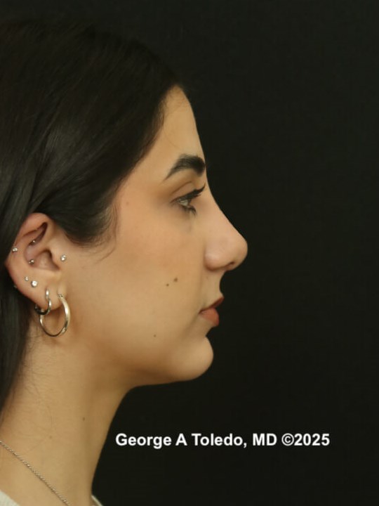 Rhinoplasty Results After