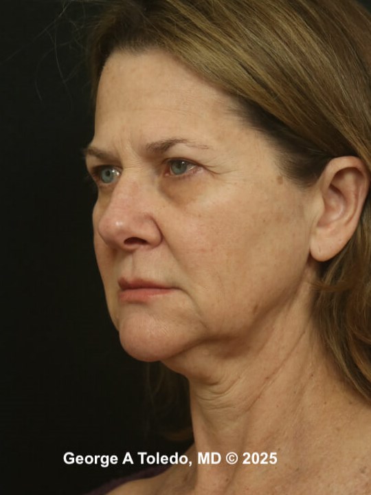 Facelift Rhinoplasty Results Before